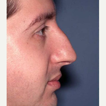25-34 year old man treated with Rhinoplasty before 3705174