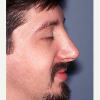 25-34 year old man treated with Rhinoplasty after 3705174