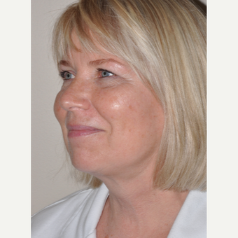 55-64 year old woman treated with Facelift after 3455590