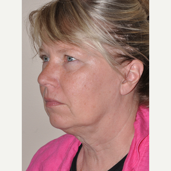 55-64 year old woman treated with Facelift before 3455590