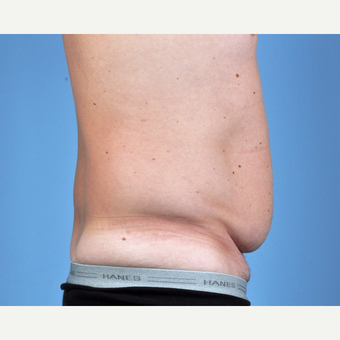 35-44 year old man treated with Tummy Tuck before 3837549