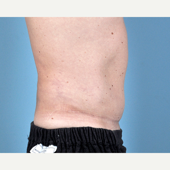 35-44 year old man treated with Tummy Tuck after 3837549