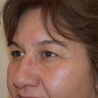 47 year-old female 6 weeks post upper eyelid blepharoplasty before 2852076