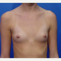 18-24 year old woman treated with Breast Implants before 3669388