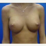 18-24 year old woman treated with Breast Implants after 3669388