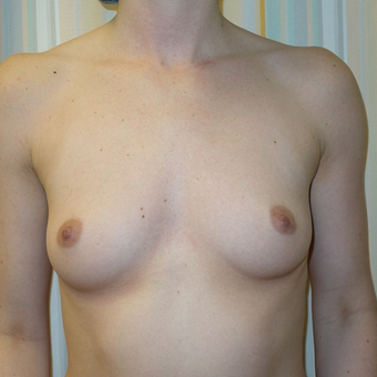 18-24 year old woman treated with Breast Augmentation before 3108777