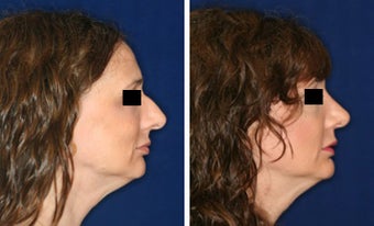 Nose Surgery before 1430824
