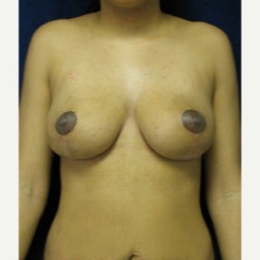 Vertical type breast lift without implants after 1591493