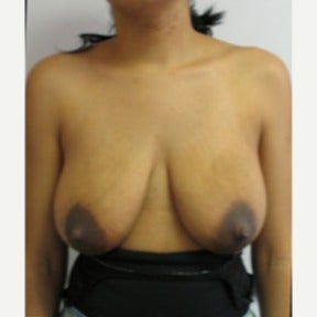 Vertical type breast lift without implants before 1591493