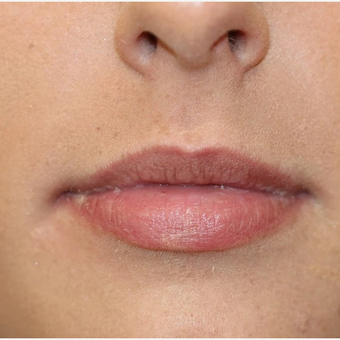 Lip augmentation - Dermal Fillers - 21 before 3107201