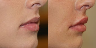 Lip augmentation - Dermal Fillers - 21 3107201