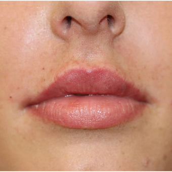 Lip augmentation - Dermal Fillers - 21 after 3107201