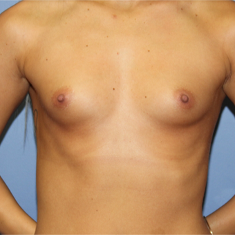 25-34 year old woman treated with Breast Augmentation before 3214588