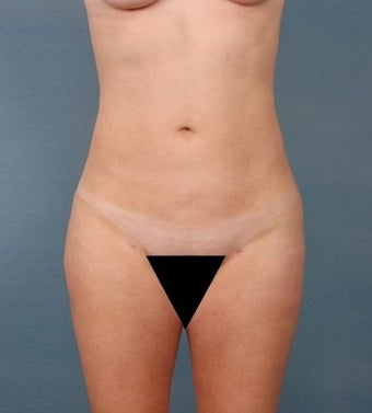 39 year old woman treated with Vaser Liposuction after 1699823