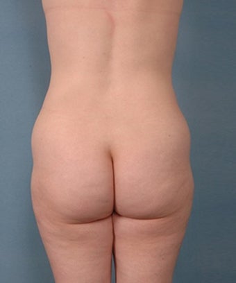 39 year old woman treated with Vaser Liposuction 1699823