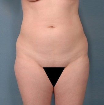 39 year old woman treated with Vaser Liposuction before 1699823
