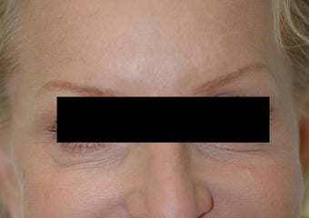 Botox for Crow's Feet after 91056