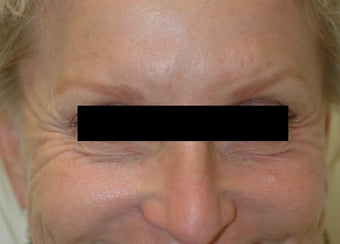 Botox for Crow's Feet before 91056