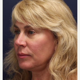 45-54 year old woman treated with Ultherapy before 3141819