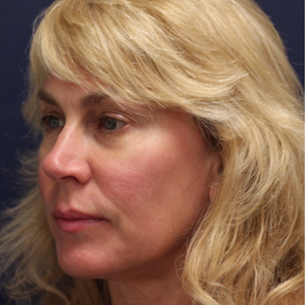 45-54 year old woman treated with Ultherapy after 3141819