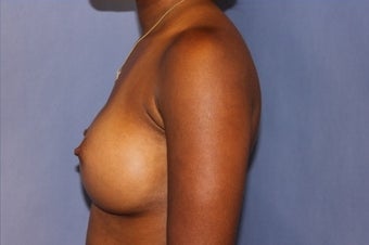 Breast Augmentation Mentor Memory Gel 350cc High Profile 1372177