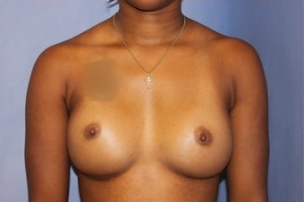 Breast Augmentation Mentor Memory Gel 350cc High Profile after 1372177