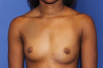 Breast Augmentation Mentor Memory Gel 350cc High Profile before 1372177