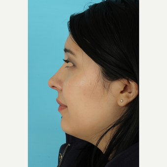 25-34 year old woman treated with Rhinoplasty after 3691295
