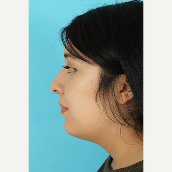 25-34 year old woman treated with Rhinoplasty before 3691295