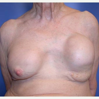 75 and up year old woman treated with Breast Reconstruction before 1585122