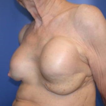 75 and up year old woman treated with Breast Reconstruction 1585122