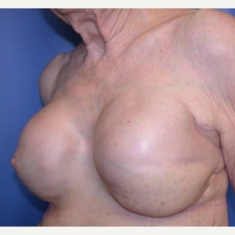 75 and up year old woman treated with Breast Reconstruction 1585122