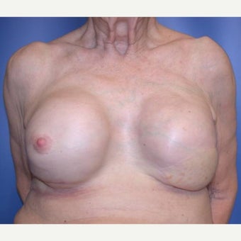 75 and up year old woman treated with Breast Reconstruction after 1585122