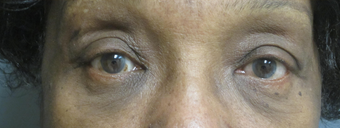 Lower eyelid bags removal after 929689