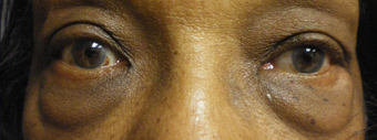 Lower eyelid bags removal before 929689