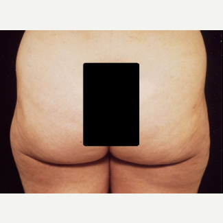 42 year old woman treated with Liposuction after 3094713