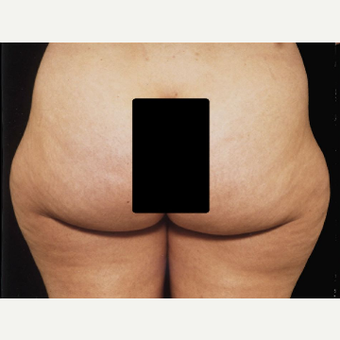42 year old woman treated with Liposuction before 3094713