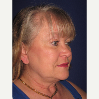 Facelift before 3831369