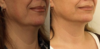 Jowl Lift - non surgical before 910736