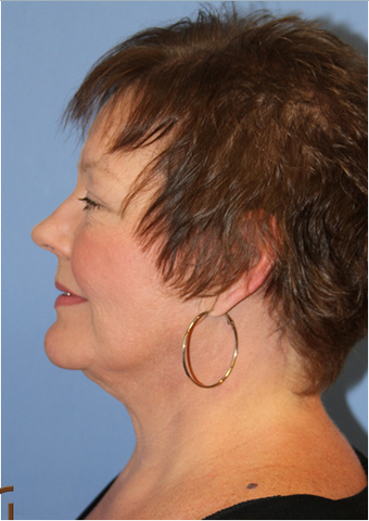Neck lift under local anesthesia and twilight sedation after 252451
