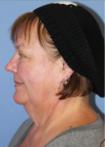 Neck lift under local anesthesia and twilight sedation before 252451