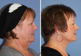 Neck lift under local anesthesia and twilight sedation 252451