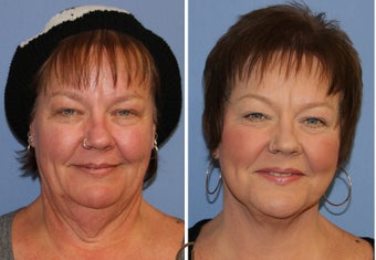 Neck lift under local anesthesia and twilight sedation 252451