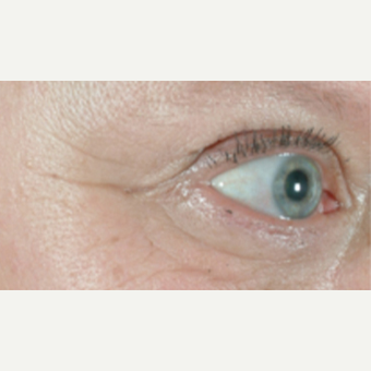 45-54 year old woman treated with Skin Rejuvenation before 3141939