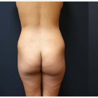 25-34 year old woman treated with Liposuction before 3731911
