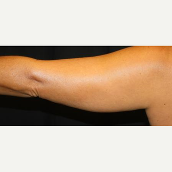 35-44 year old woman treated with CoolSculpting before 2033761
