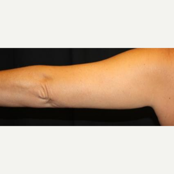35-44 year old woman treated with CoolSculpting after 2033761