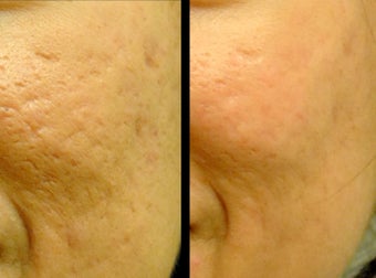 1540 Laser before 977536