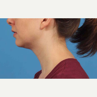 25-34 year old woman treated with Chin Liposuction after 3787648