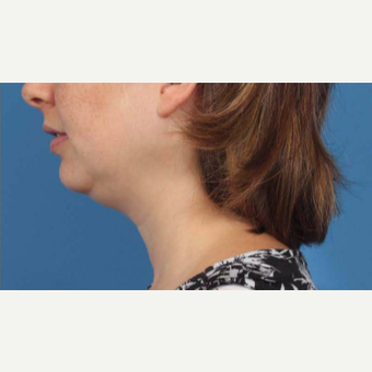25-34 year old woman treated with Chin Liposuction before 3787648